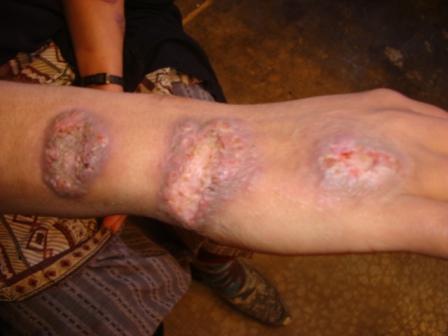 Large leishmaniasis skin lesions on forearm Large leishmaniasis skin lesions on forearm