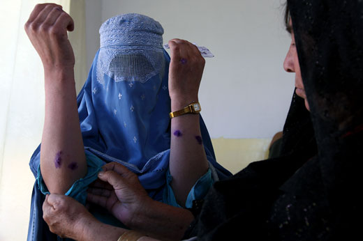 Leishmania, a disease of poverty,  poses a huge social burden in Afghanistan. When not treated in a timely way, the disease leaves  lesions and scars; sometimes preventing young girls from getting married. 