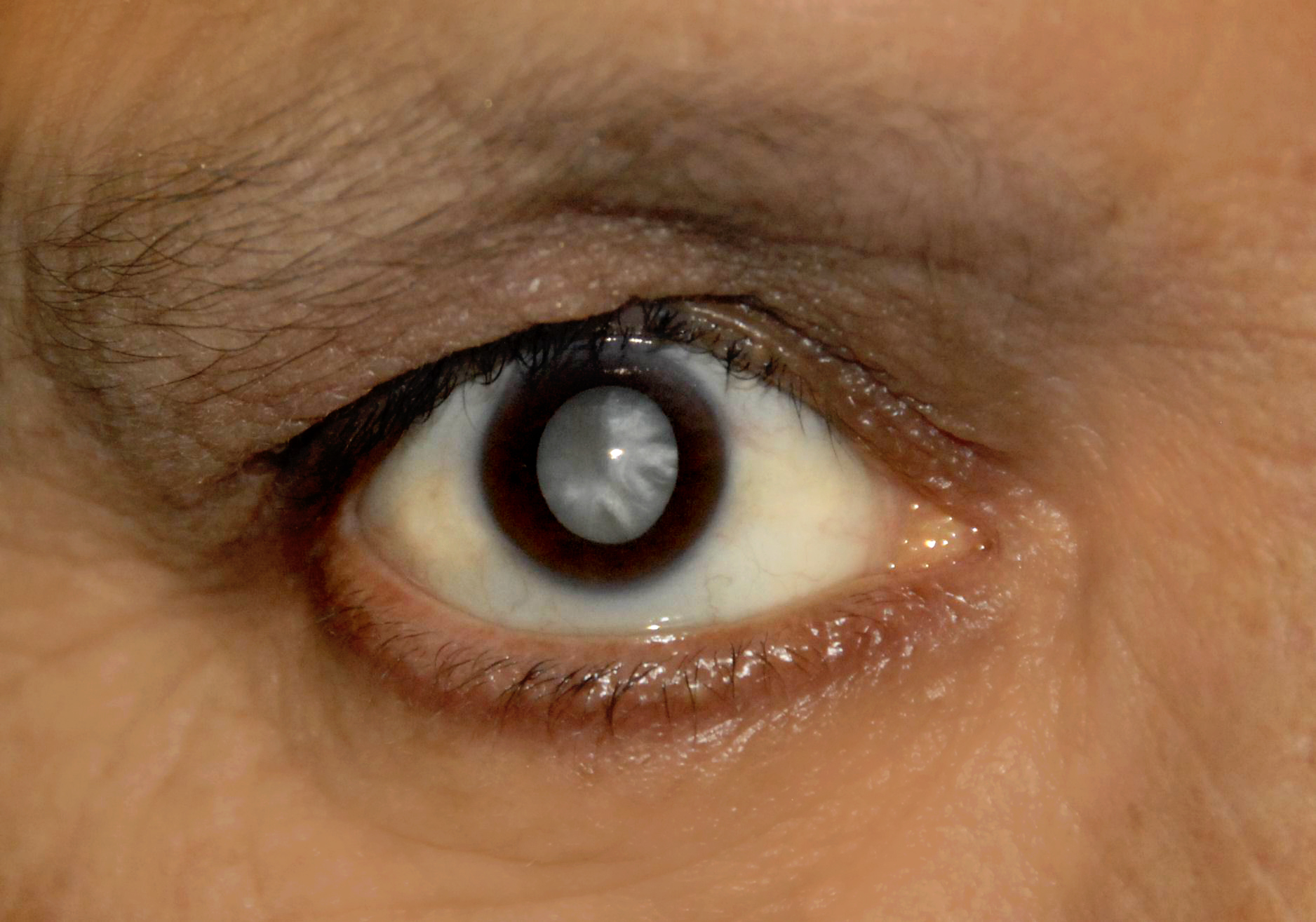 Image of an eye with cataract