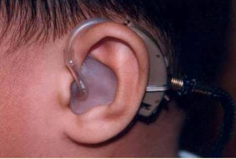 Image shows a child's ear and hearing aid
