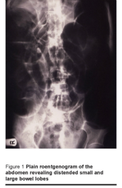 Figure 1 Plain roentgenogram of the abdomen revealing distended small and large bowel lobes