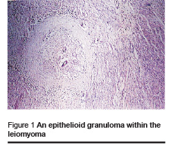 Figure 1 An epithelioid granuloma within the leiomyoma