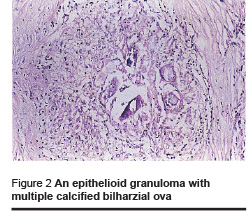 Figure 2 An epithelioid granuloma with multiple calcified bilharzial ova