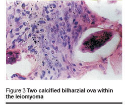 Figure 3 Two calcified bilharzial ova within the leiomyoma