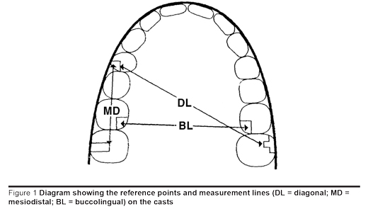 Figure 1 Diagram showing the reference points and measurement lines (DL = diagonal; MD = mesiodistal; BL = buccolingual) on the casts