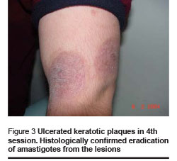 Figure 3 Ulcerated keratotic plaques in 4th session. Histologically confirmed eradication of amastigotes from the lesions