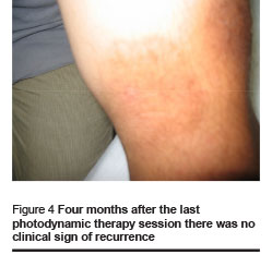 Figure 4 Four months after the last photodynamic therapy session there was no clinical sign of recurrence