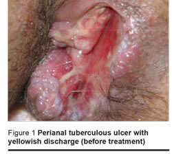 Figure 1 Perianal tuberculous ulcer with yellowish discharge (before treatment)