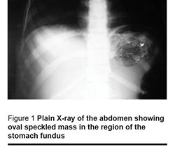 Figure 1 Plain X-ray of the abdomen showing oval speckled mass in the region of the stomach fundus