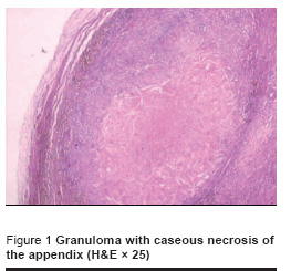 Figure 1 Granuloma with caseous necrosis of  the appendix (H&E × 25)