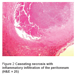 Figure 2 Caseating necrosis with  inflammatory infiltration of the peritoneum  (H&E × 25)