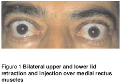 Figure 1 Bilateral upper and lower lid retraction and injection over medial rectus muscles