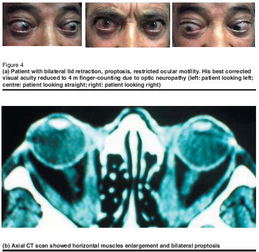 Figure 4  (a) Patient with bilateral lid retraction, proptosis, restricted ocular motility. His best corrected visual acuity reduced to 4 m finger-counting due to optic neuropathy (left: patient looking left; centre: patient looking straight; right: patient looking right)  (b) Axial CT scan showed horizontal muscles enlargement and bilateral proptosis