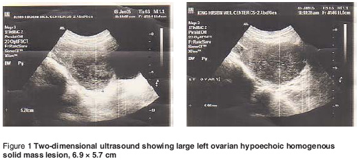 Figure 1 Two-dimensional ultrasound showing large left ovarian hypoechoic homogenous  solid mass lesion, 6.9 × 5.7 cm