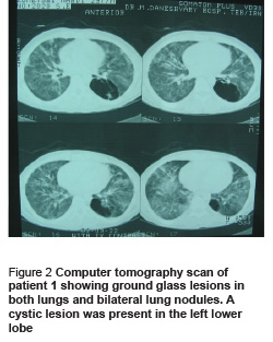 Figure 2 Computer tomography scan of patient 1 showing ground glass lesions in both lungs and bilateral lung nodules. A cystic lesion was present in the left lower lobe