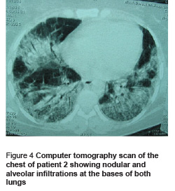 Figure 4 Computer tomography scan of the chest of patient 2 showing nodular and alveolar infiltrations at the bases of both lungs