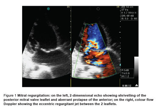 Figure 1 Mitral regurgitation: on the left, 2-dimensional echo showing shrivelling of the  posterior mitral valve leaflet and aberrant prolapse of the anterior; on the right, colour flow  Doppler showing the eccentric regurgitant jet between the 2 leaflets.