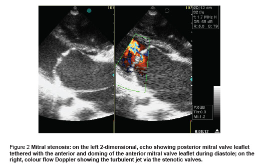 Figure 2 Mitral stenosis: on the left 2-dimensional, echo showing posterior mitral valve leaflet  tethered with the anterior and doming of the anterior mitral valve leaflet during diastole; on the  right, colour flow Doppler showing the turbulent jet via the stenotic valves.