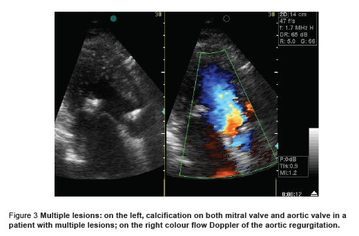 Figure 3 Multiple lesions: on the left, calcification on both mitral valve and aortic valve in a  patient with multiple lesions; on the right colour flow Doppler of the aortic regurgitation