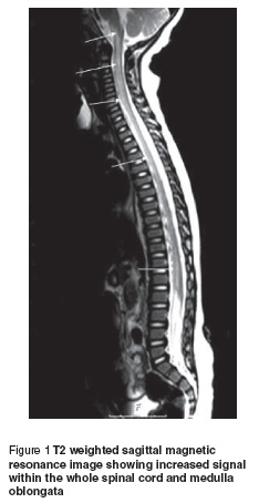 Figure 1 T2 weighted sagittal magnetic  resonance image showing increased signal  within the whole spinal cord and medulla  oblongata