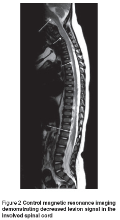 Figure 2 Control magnetic resonance imaging  demonstrating decreased lesion signal in the  involved spinal cord