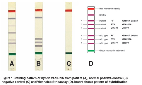 Figure 1 Staining pattern of hybridized DNA from patient (A), normal positive control (B),  negative control (C) and Viennalab Stripassay (D). Insert shows pattern of hybridization