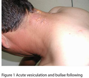 Figure 1 Acute vesiculation and bullae following contact with the insect 