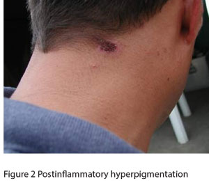 Figure 2 Postinflammatory hyperpigmentation following the insect injury