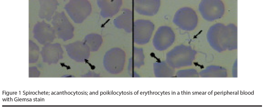 Figure 1 Spirochete; acanthocytosis; and poikilocytosis of erythrocytes in a thin smear of peripheral blood with Giemsa stain