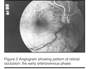 Figure 2 Angiogram showing pattern of retinal occlusion: the early arteriovenous phase