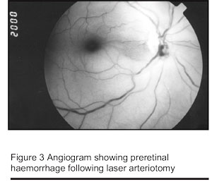 Figure 3 Angiogram showing preretinal haemorrhage following laser arteriotomy