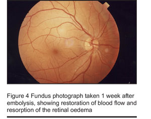 Figure 4 Fundus photograph taken 1 week after embolysis, showing restoration of blood flow and resorption of the retinal oedema