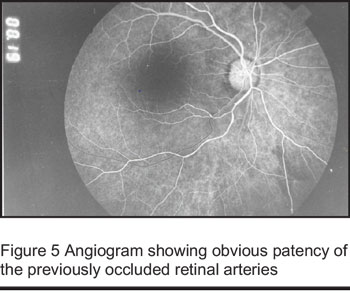 Figure 5 Angiogram showing obvious patency of the previously occluded retinal arteries