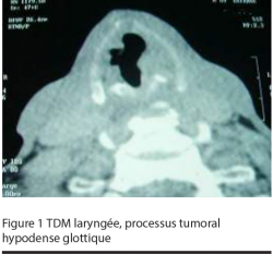 Figure 1 TDM laryngée, processus tumoral hypodense glottique
