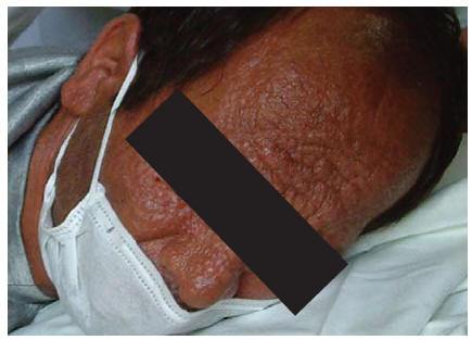Figure 1 Distribution of the skin lesions on the face in case 1: erythematous papules and nodules with central ulceration covered with haematic crusts 