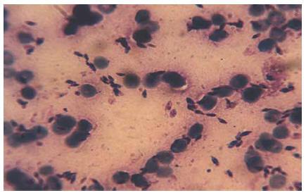 Figure 2 Leishman bodies in the Glemsa-stained smear, prepared from skin lesions of case 1 (x1000)