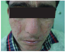 Figure 1 Patient 1 showing large atrophic plaques on both sides of his face. There were some red infiltrative nodules at the margin of the lesions.