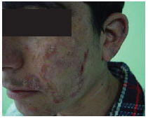 Figure 1 Patient 1 showing large atrophic plaques on both sides of his face. There were some red infiltrative nodules at the margin of the lesions.