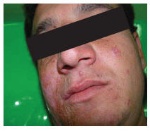 Figure 3 Patient 2 showing large atrophic scar on one side of his face and nose with red infiltrative nodules