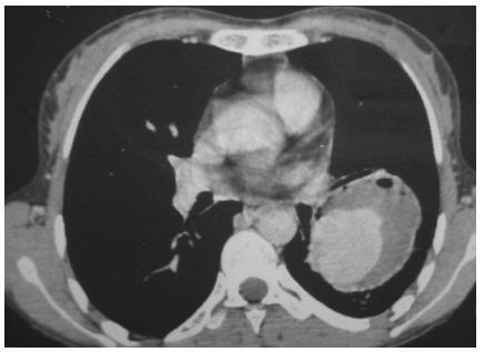 Figure 1 Computerized tomography scan of the thorax with contrast showing a large cavity at the inferior lobe with extension to the hill and adhesion to the chest wall, indicating a large pulmonary artery aneurysm 