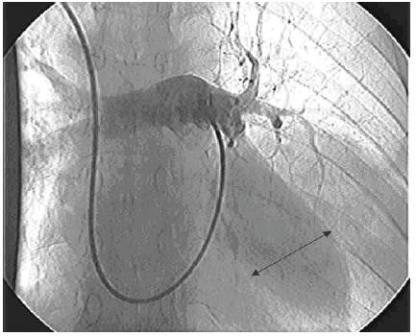 Figure 2 Digital subtraction angiography showing a cavity at the pulmonary artery