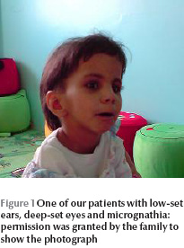Figure 1 One of our patients with low-set