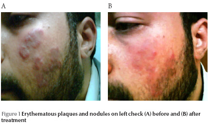 Figure 1 Erythematous plaques and nodules on left check (A) before and (B) after