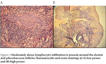 Figure 2 Moderately dense lymphocytic infiltration is present around the dermis