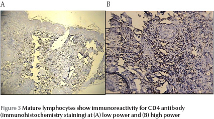 Figure 3 Mature lymphocytes show immunoreactivity for CD4 antibody