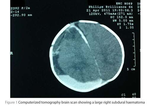 Figure 1 Computerized tomography brain scan showing a large right subdural haematoma
