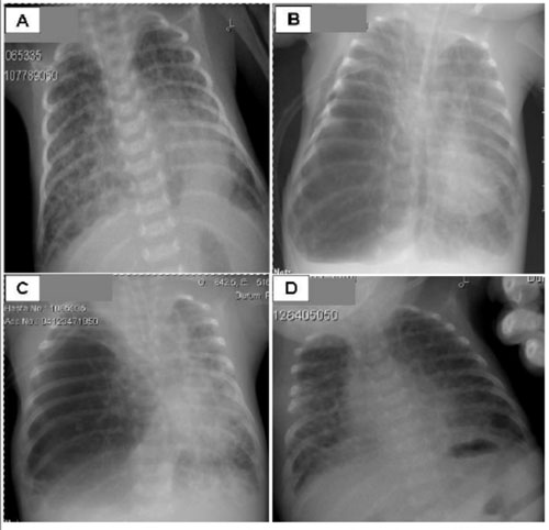 Figure 1 Chest radiographs of a case of acquired lobar emphysema mimicking pneumothorax in a neonate. (A) Postnatal day 21: bilateral diffuse cystic changes in lung parenchyma, consolidation on the left retrocardiac side. (B) Postnatal day56: emphysema on the right lower lobe of the lung, deviation of the heart and mediastinal structures to the left, diffuse cystic parenchymal changes on the right upper lobe and left lobe of the lung. (C) Postnatal day 59: emphysema on the right lower lobe of the lung, deviation of the heart and mediastinal structures to the left. (D) Postnatal day 63: bilateral diffuse cystic parenchymal changes and no emphysema after right lower lobectomy