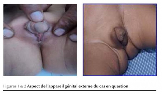 Figures 1 & 2 Aspect de l'appareil génital externe du cas en question