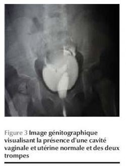 Figure 3 Image génitographique visualisant la présence d'une cavité vaginale et utérine normale et des deux trompes