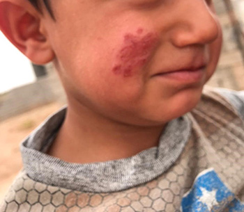 Scars of resilience: the fight against leishmaniasis in Iraq